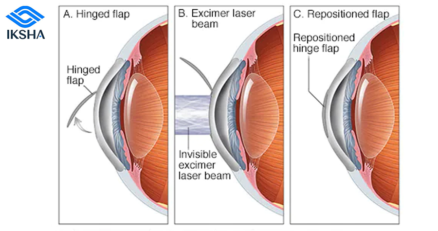 LASIK (Laser-Assisted in Situ Keratomileusis)