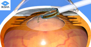Intraocular lenses (IOLs)